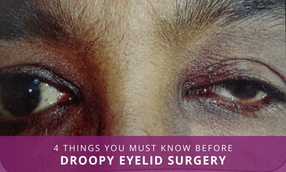 droopy eyelid surgery india