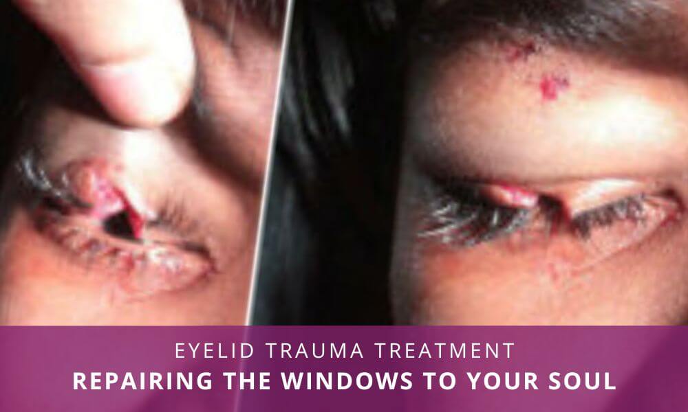 eyelid trauma treatment India