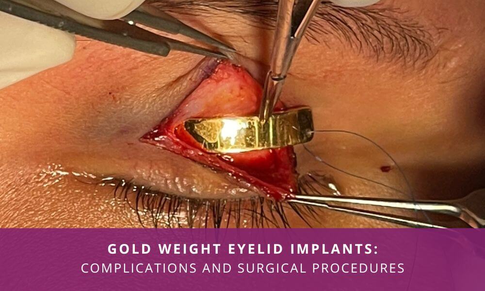 gold weight eyelid implants india