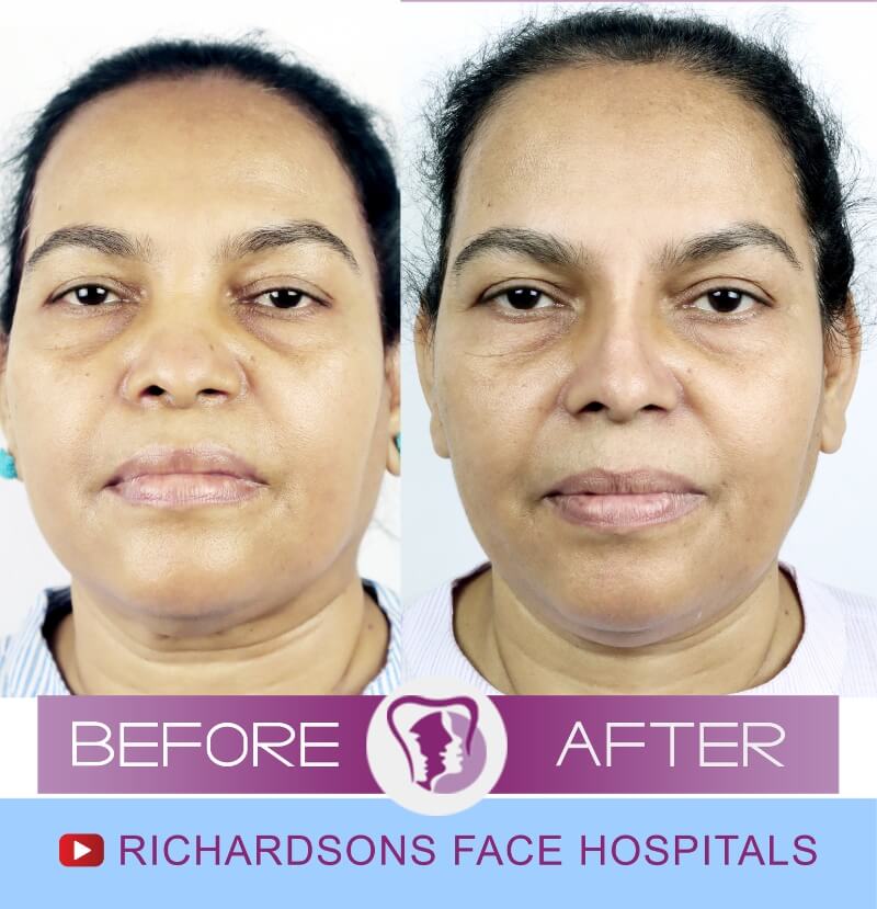 hema before after nose surgery