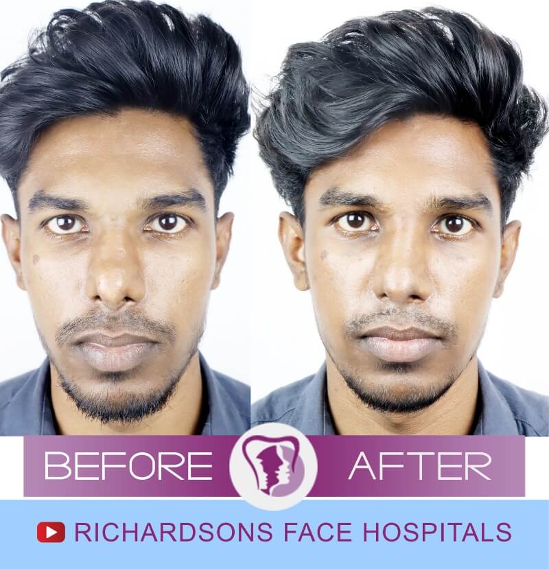 jackson before after nose surgery