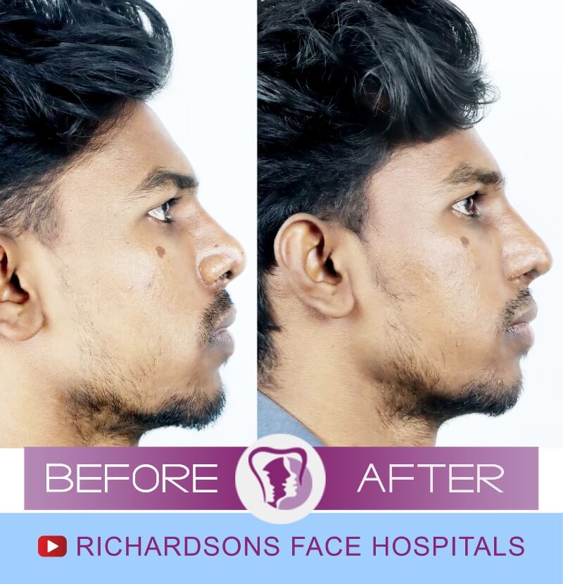 jackson nose surgery side view