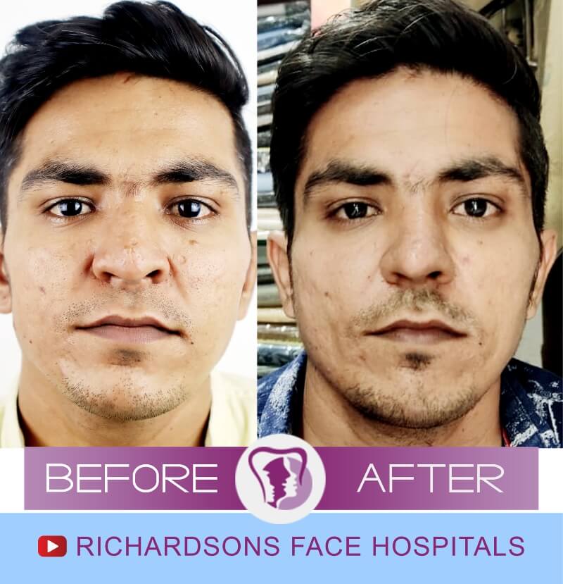 mahendran before after nose surgery