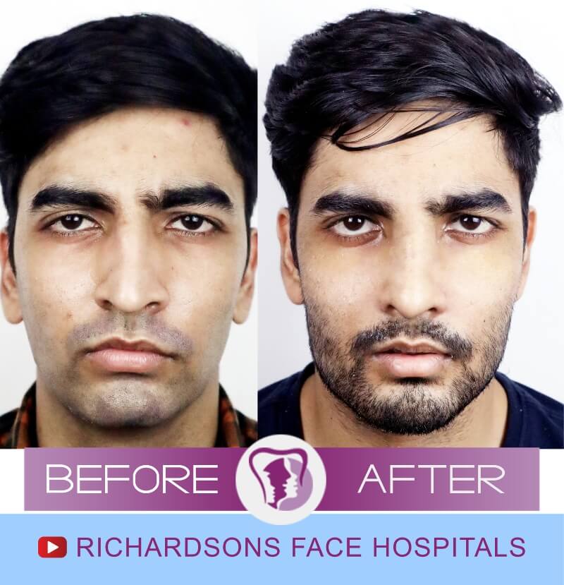 navdeep before after nose surgery