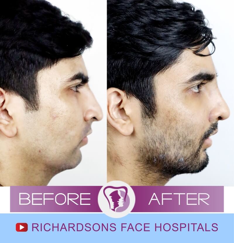 http://navdeep%20nose%20surgery%20side%20view