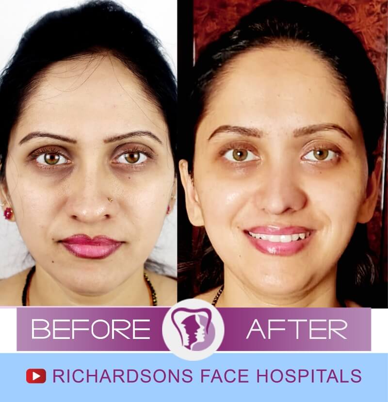http://neeta%20patel%20before%20after%20nose%20surgery
