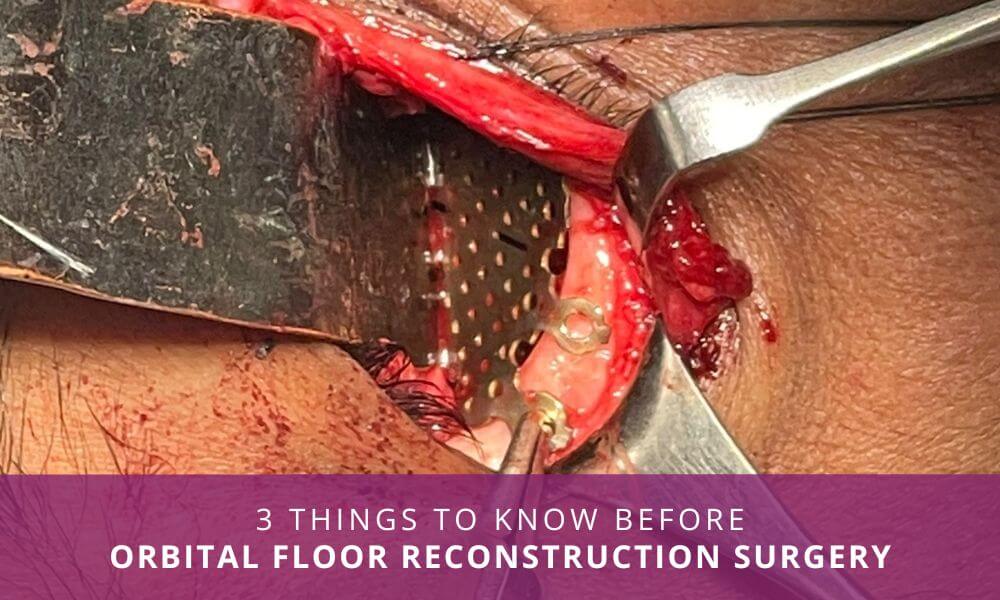 orbital floor reconstruction surgery india