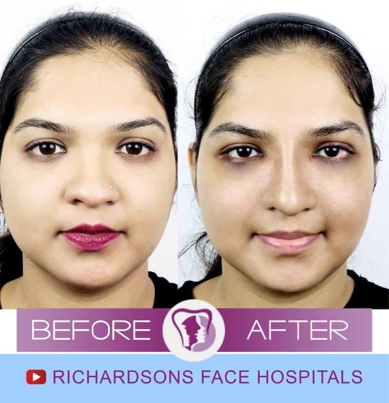 poonam before after nose surgery