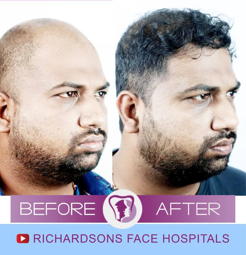 rajkumar hair transplantation side view