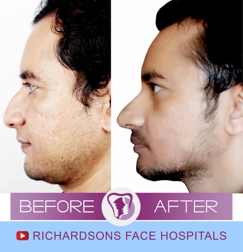 rakesh before after nose surgery