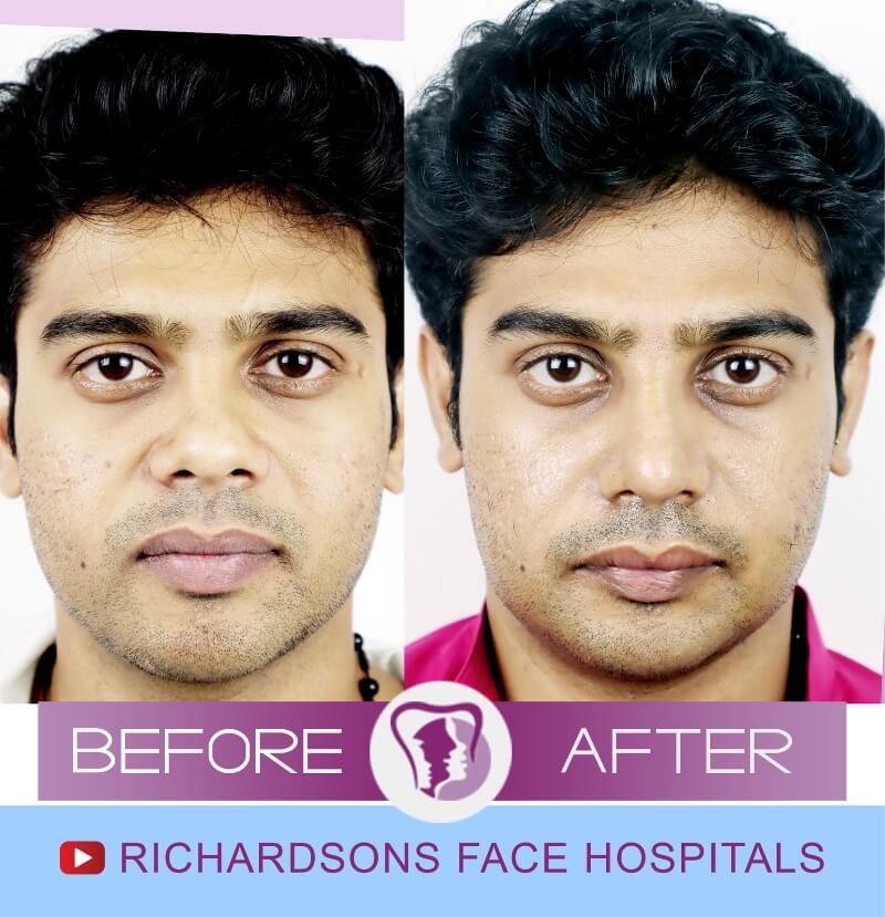 ravisankar before after nose surgery