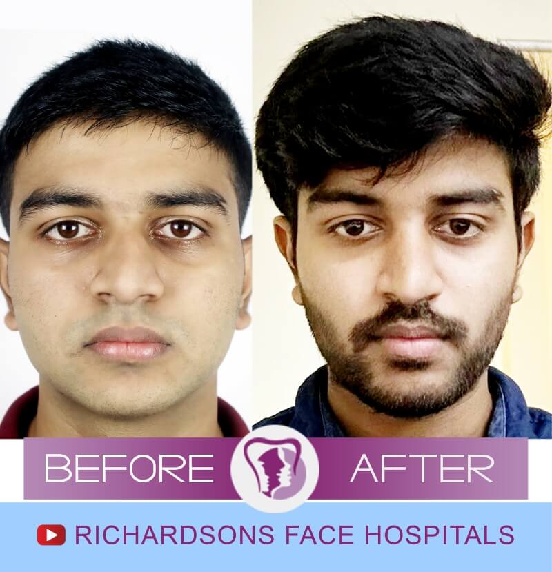 ronesh nose surgery front view