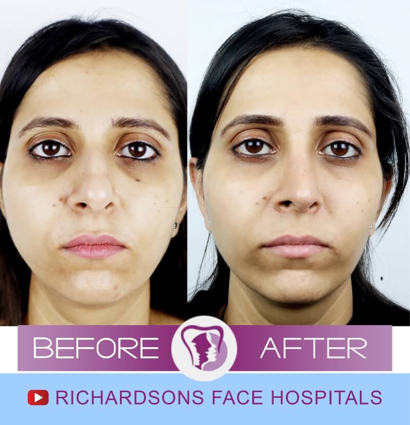 sakshi before after nose surgery