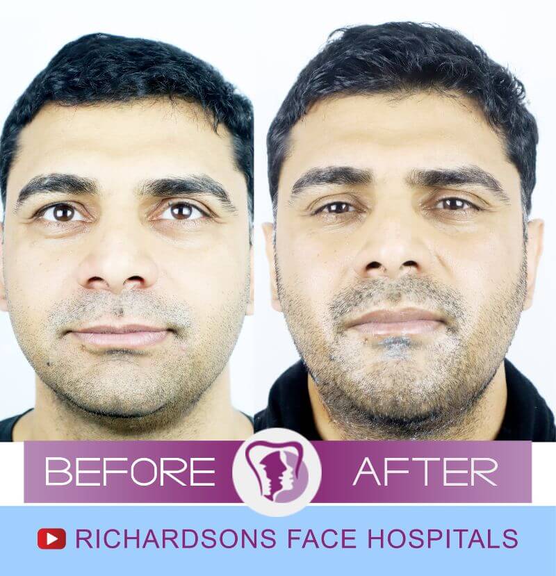 simranjit chin surgery
