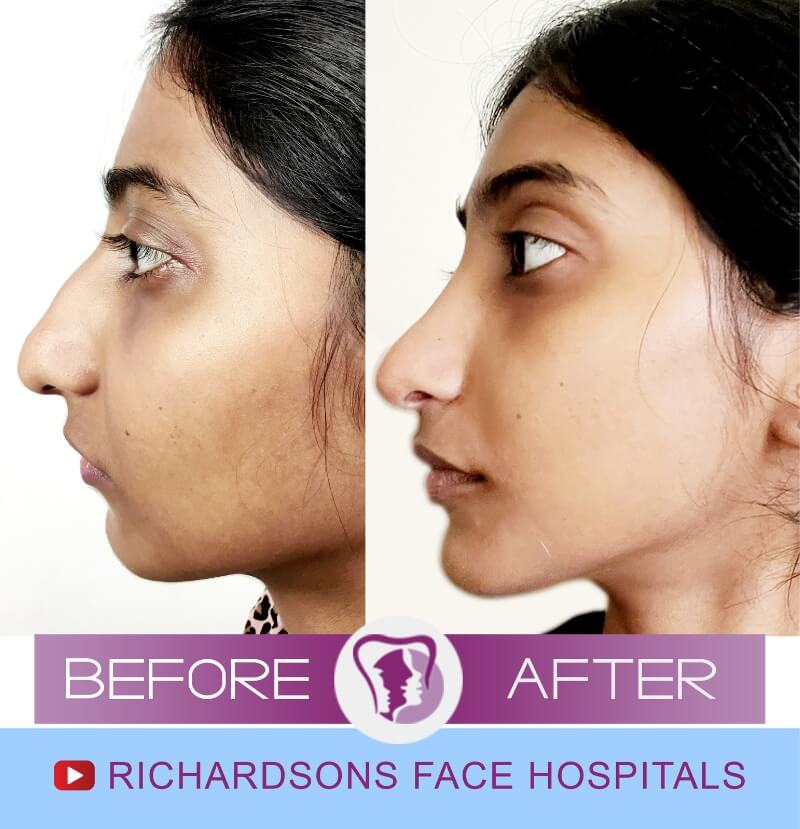 snigdha before after nose surgery side view