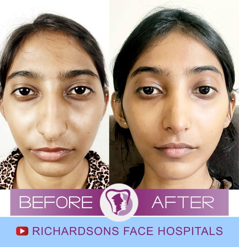 snigdha before after nose surgery