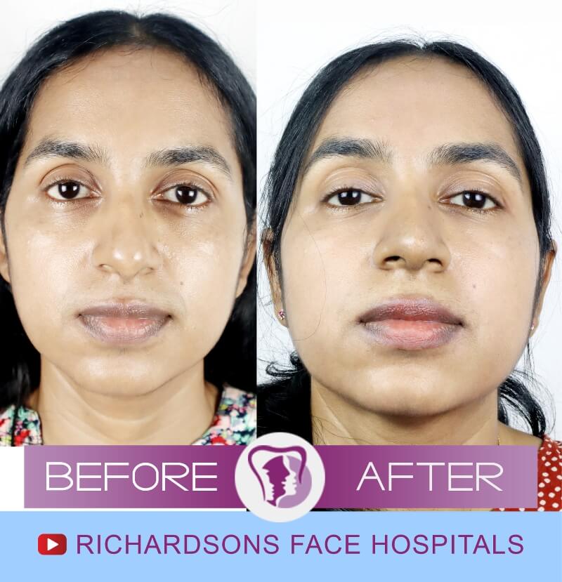 sunitha before after nose surgery