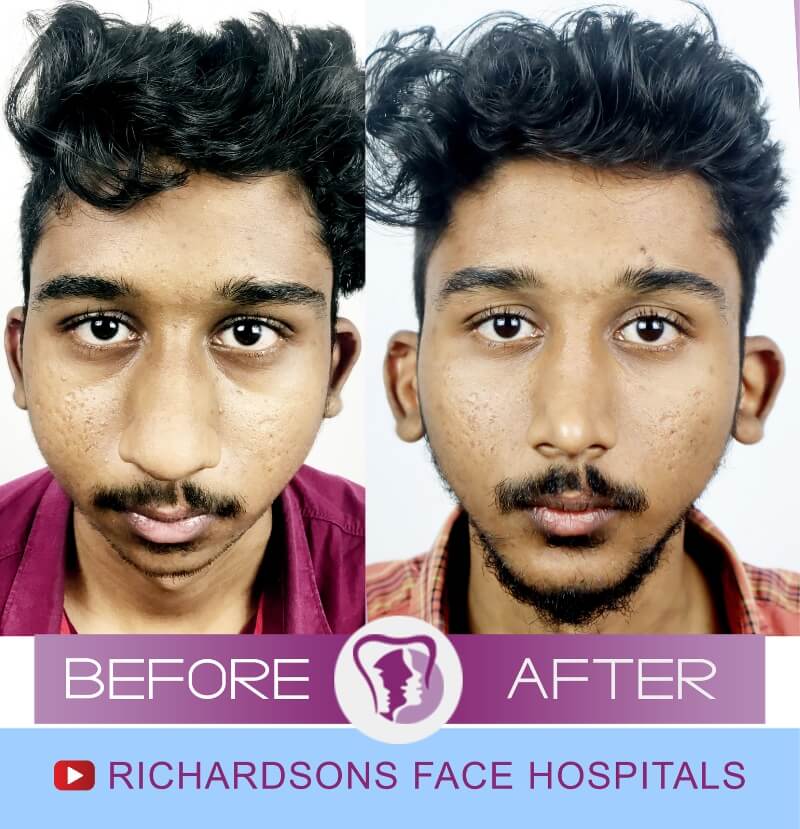 tharun before after nose and jaw surgery
