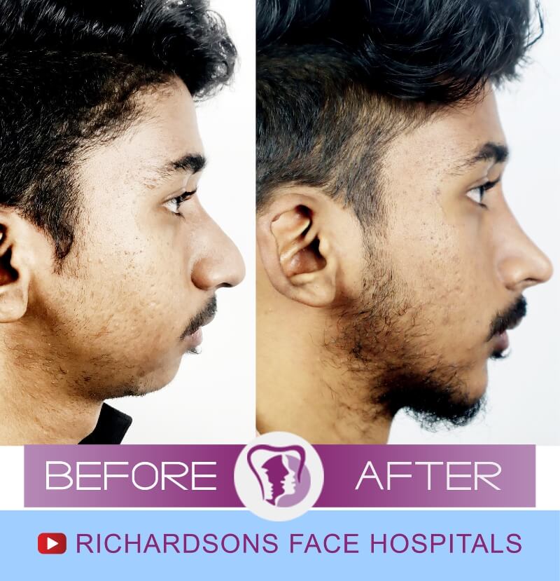 tharun nose and jaw surgery side view