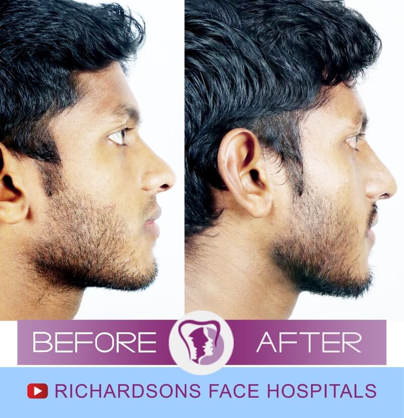 vishnu nose surgery side view
