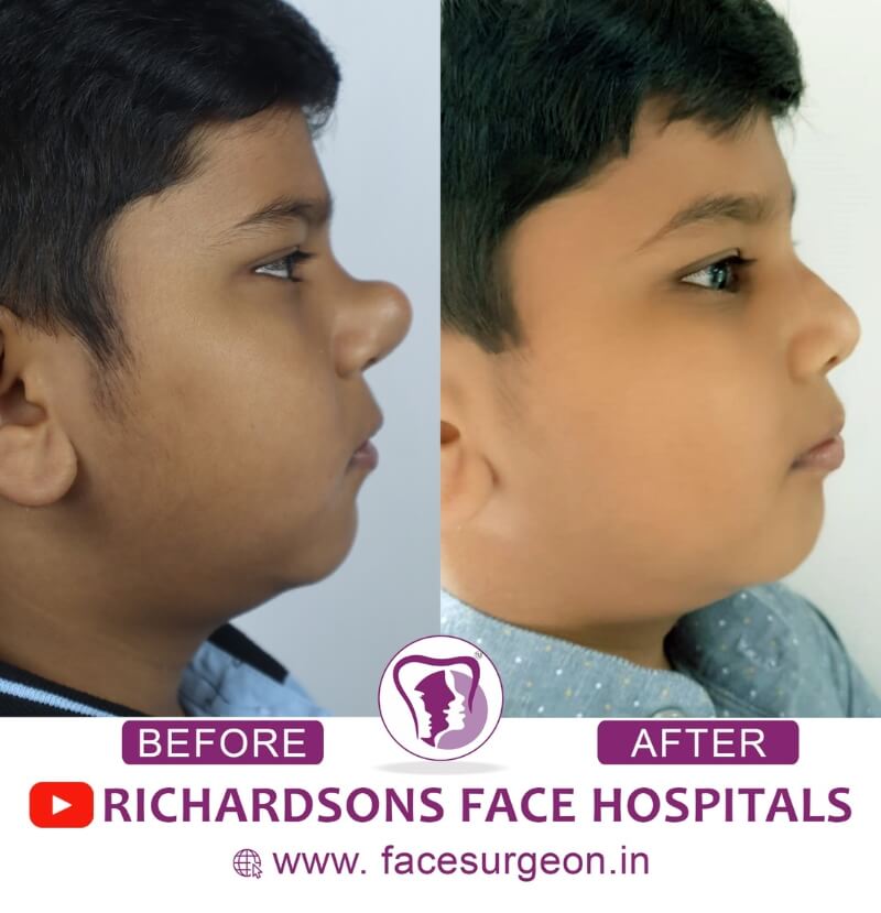 boy before after rhinoplasty surgery