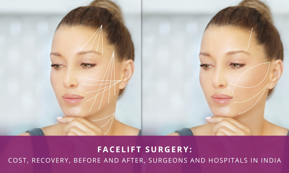 facelift surgery in india