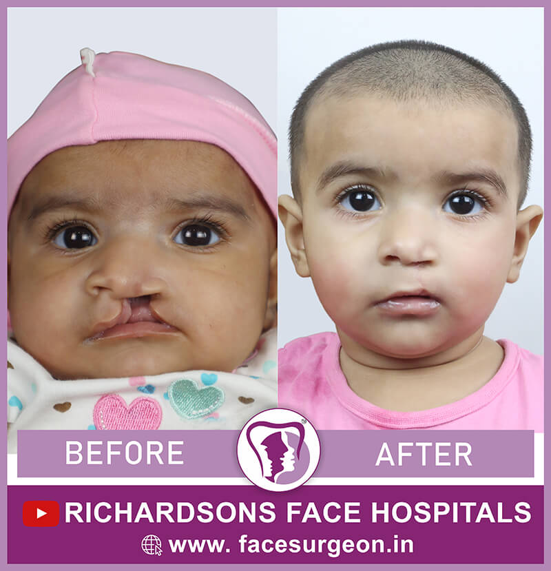 Baby Cleft Lip Surgery