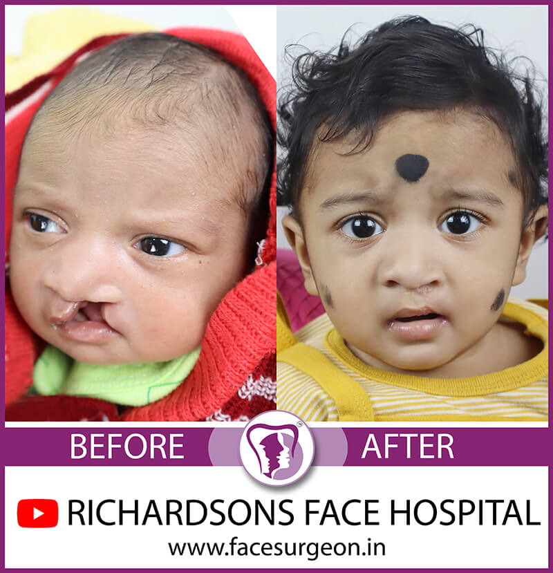 Baby Cleft Lip Surgery