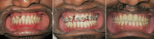 Cleft-Orthodontics