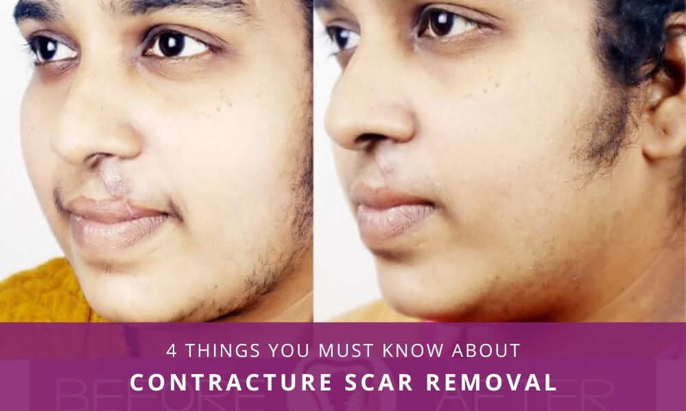 Contracture Scar Removal