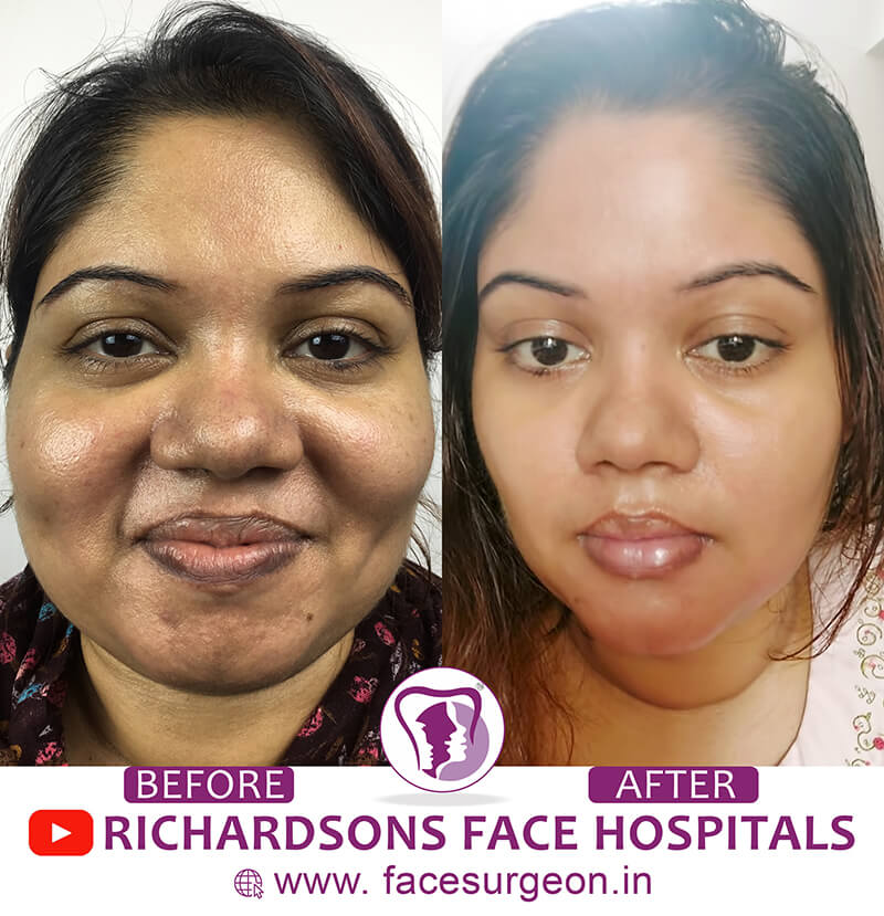 Face Makeover Surgery