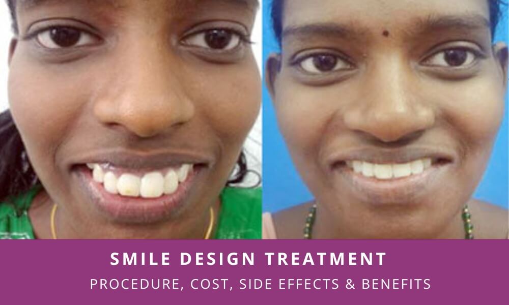 Smile Design Treatment