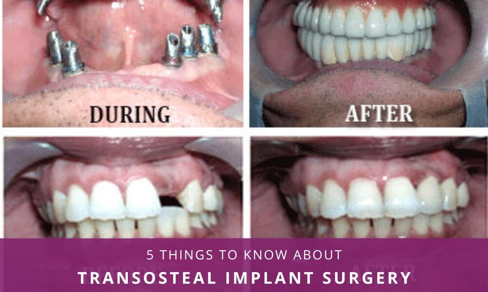 Transosteal Implant Surgery