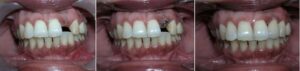 best-dental-implant-treatment