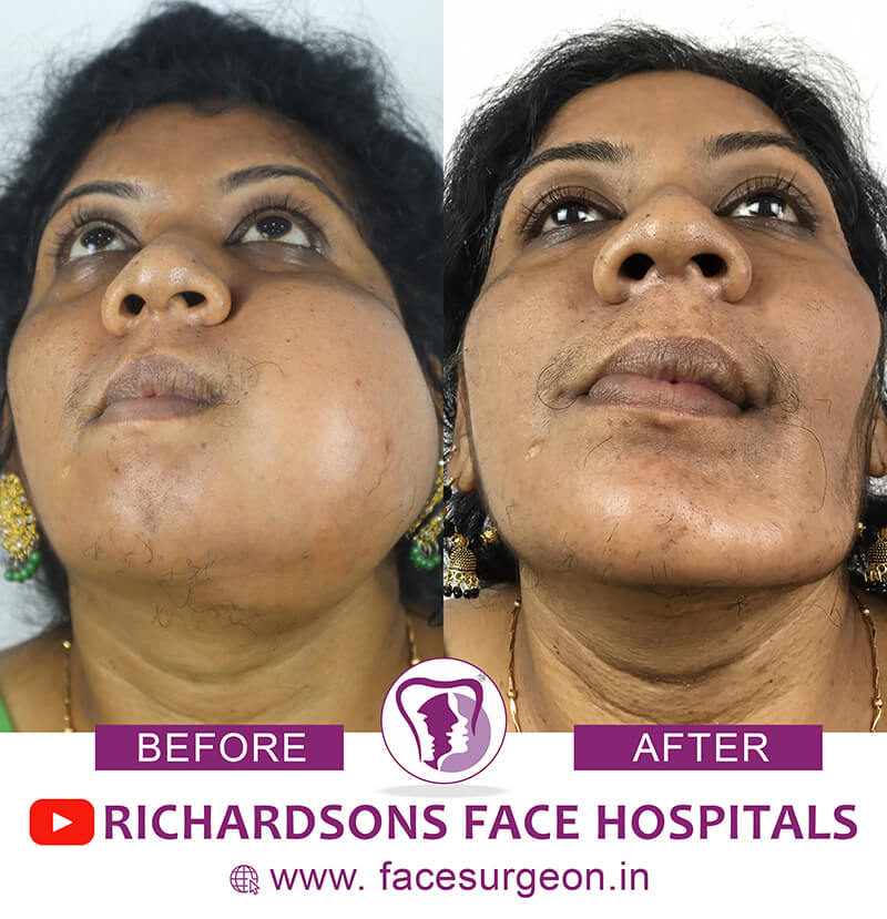 Face Tumor Removal Surgery
