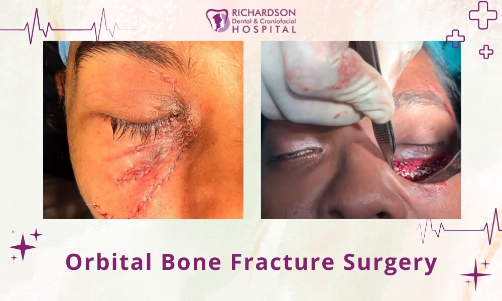 orbital bone fracture surgery