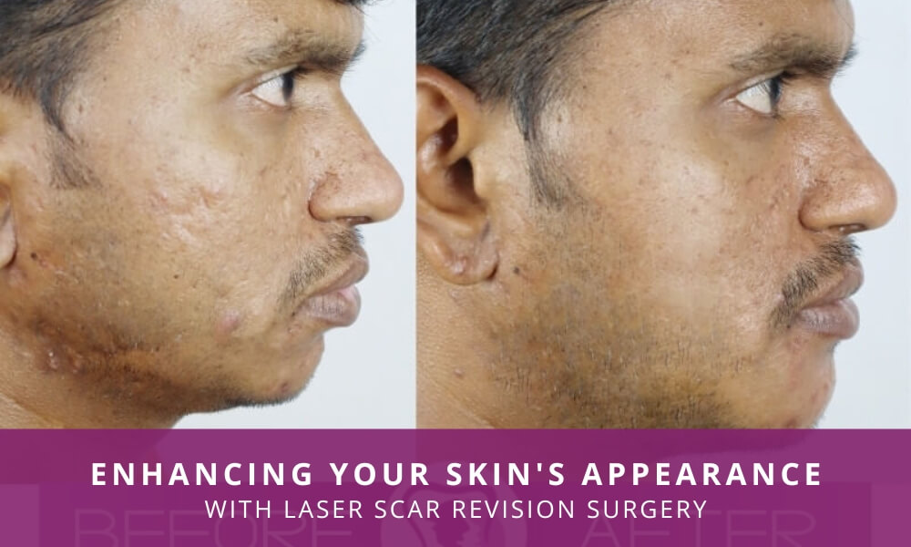 Laser facial scar revision surgery