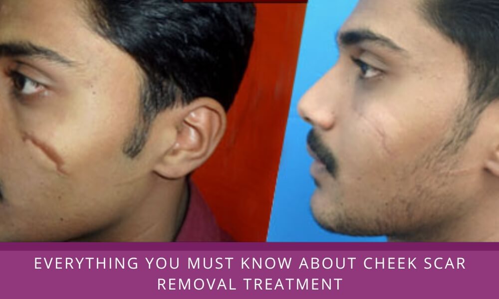 Cheek scar removal