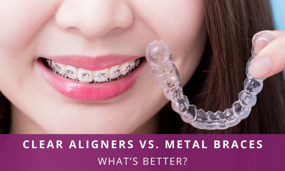 Clear aligners Vs Metal braces