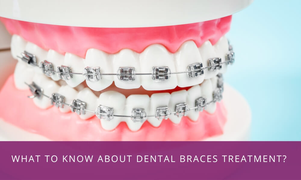 Dental Braces Treatment.