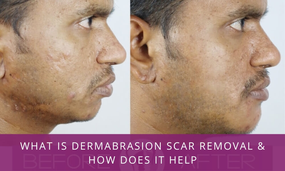 Dermabrasion scar removal