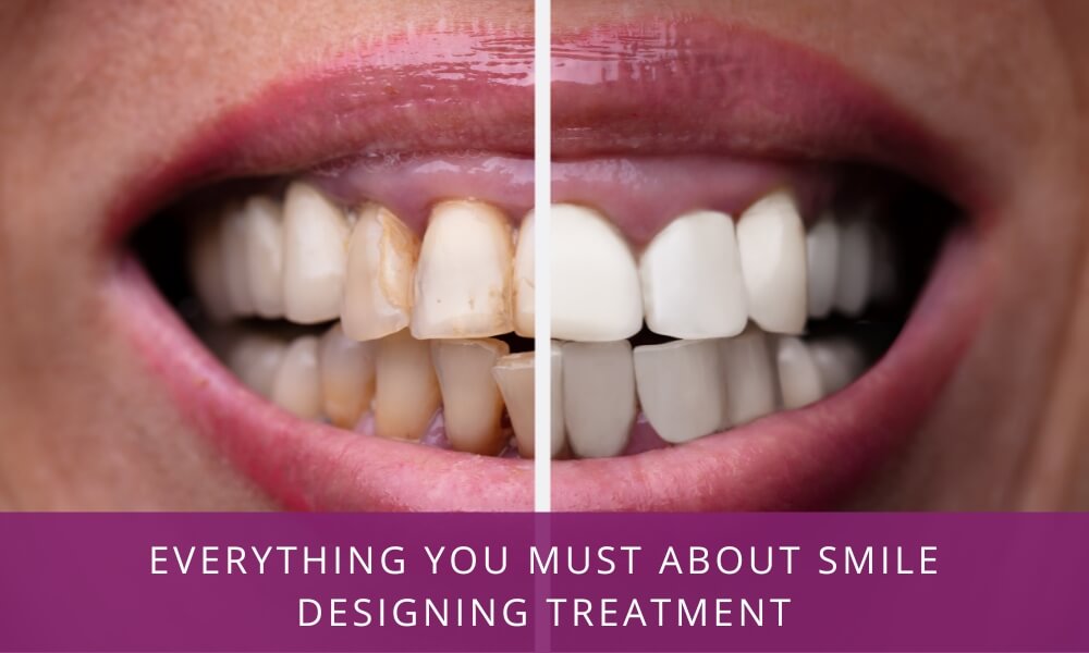 Smile Designing Treatment