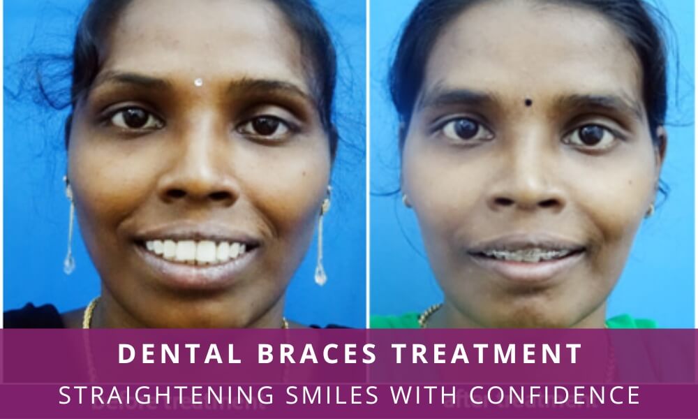 Straightening Smile with Confidence