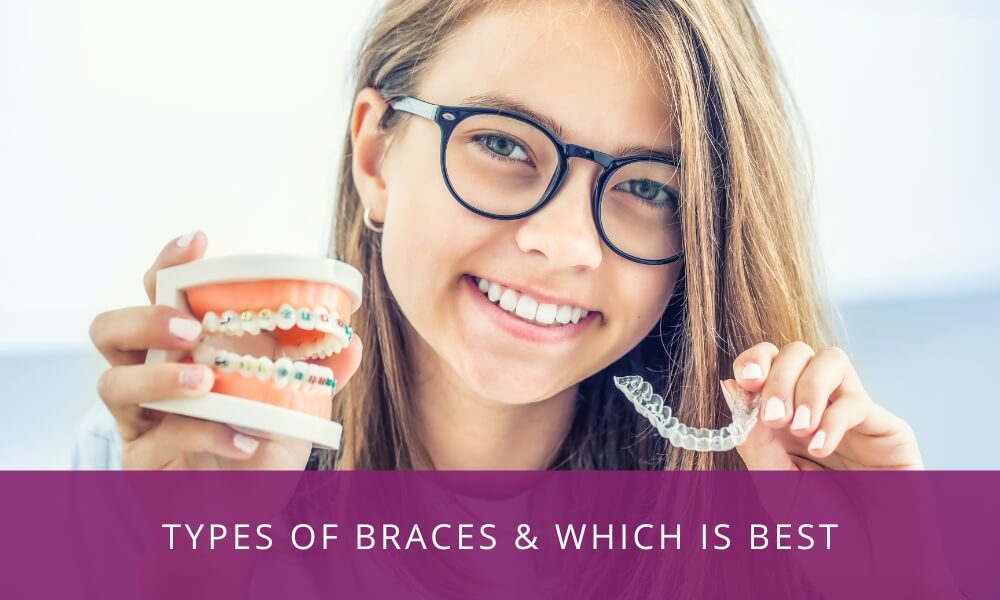 Types of braces&Which is best