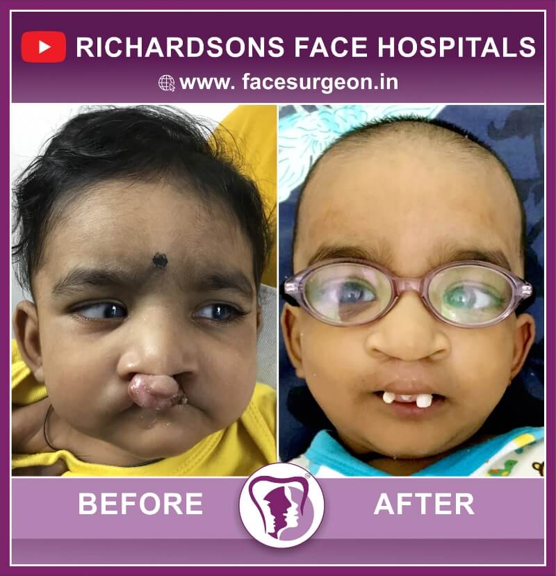 Baby Cleft Lip Repair Before After