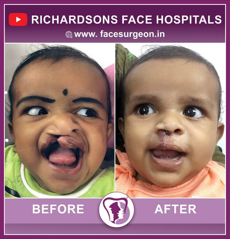Baby Cleft Lip Repair Treatment Front View