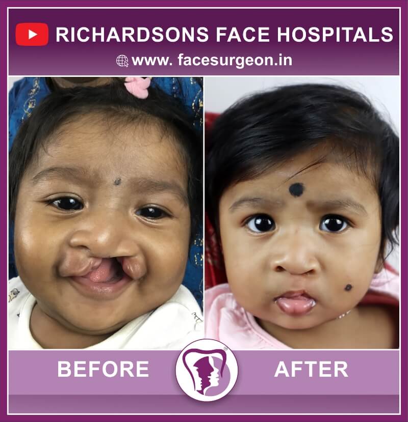 Baby Cleft Lip Surgery Results