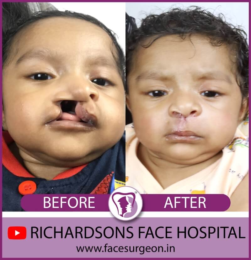 Baby Cleft Lip Treatment