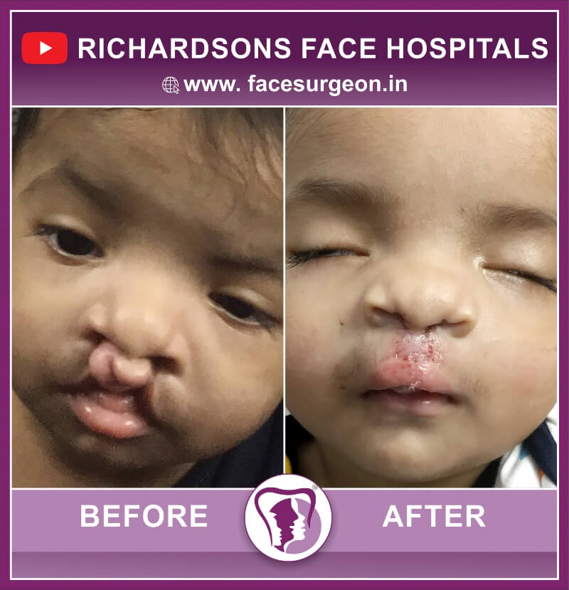 Before and After of Baby Cleft Lip Surgery