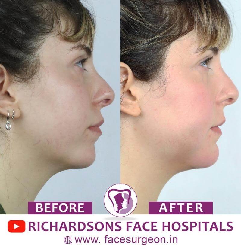http://Before%20and%20After%20of%20Chin%20Plastic%20Surgery